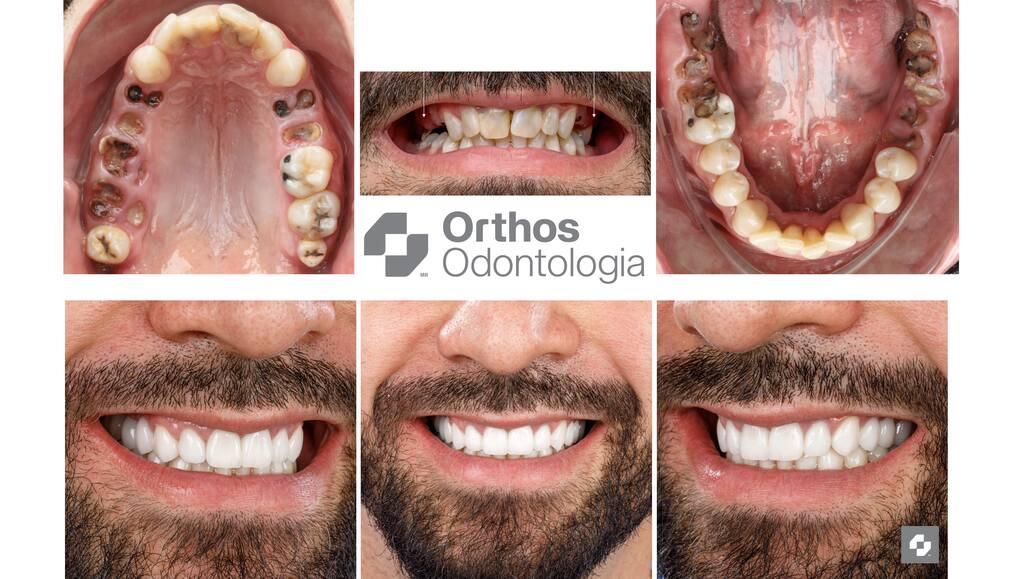 Antes e depois de tratamento de odontologia estética realizado na Clínica Orthos em Joinville.
