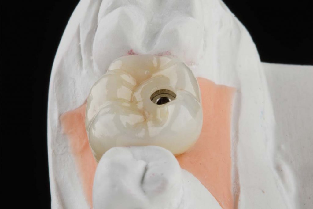 Manutenção dos Dentes Implantados