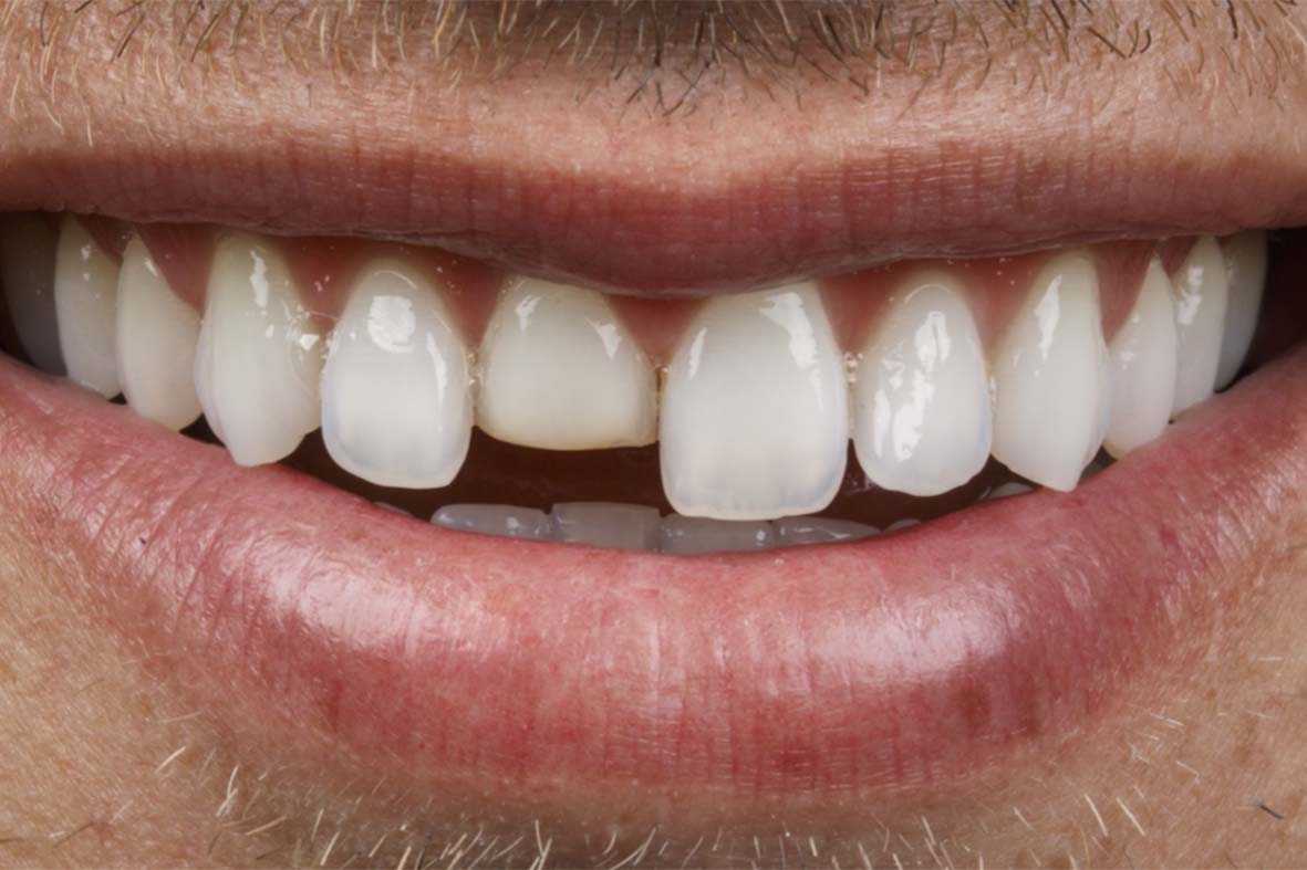 Você sabe como ocorre a fratura dentária?