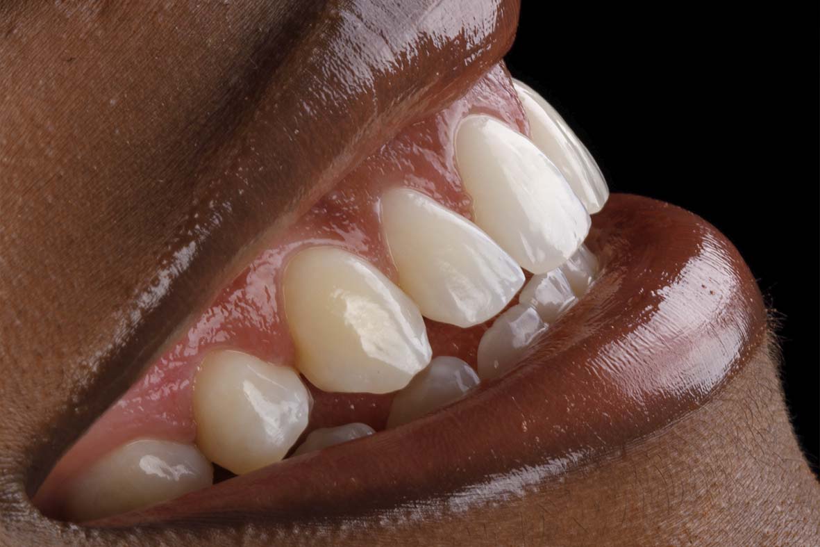 raspagem periodontal