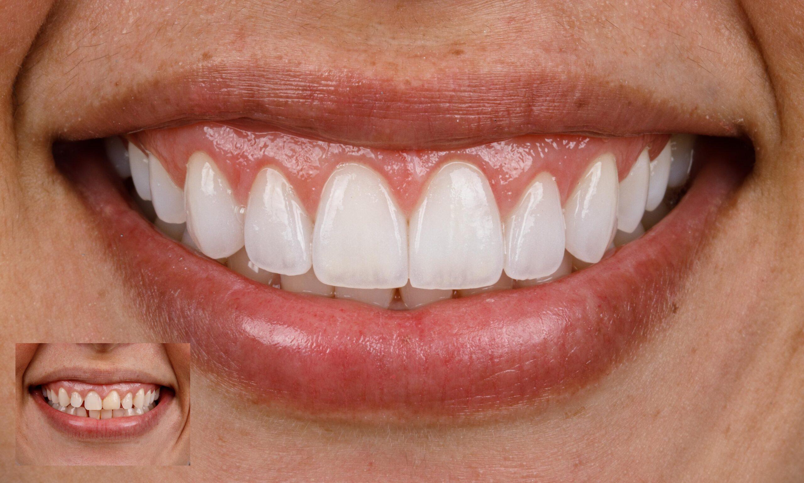 diastema scaled