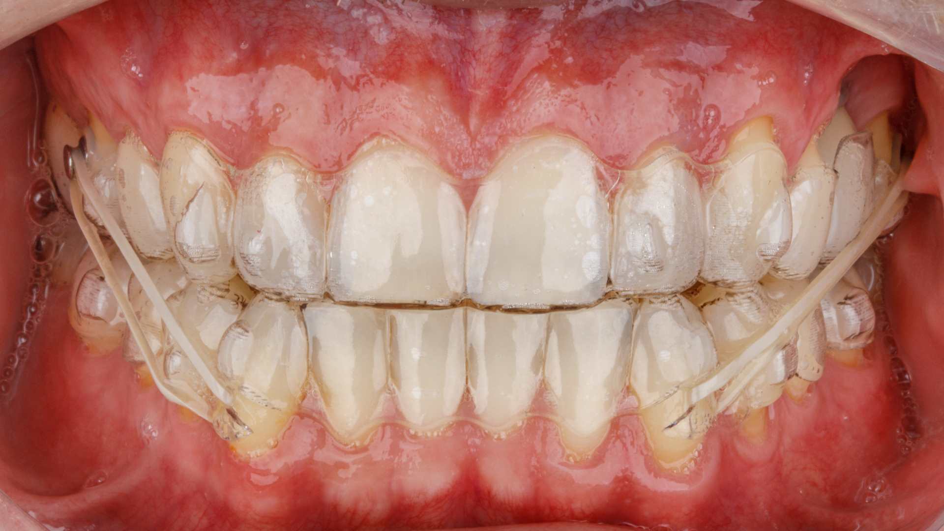 ortodontia invisivel