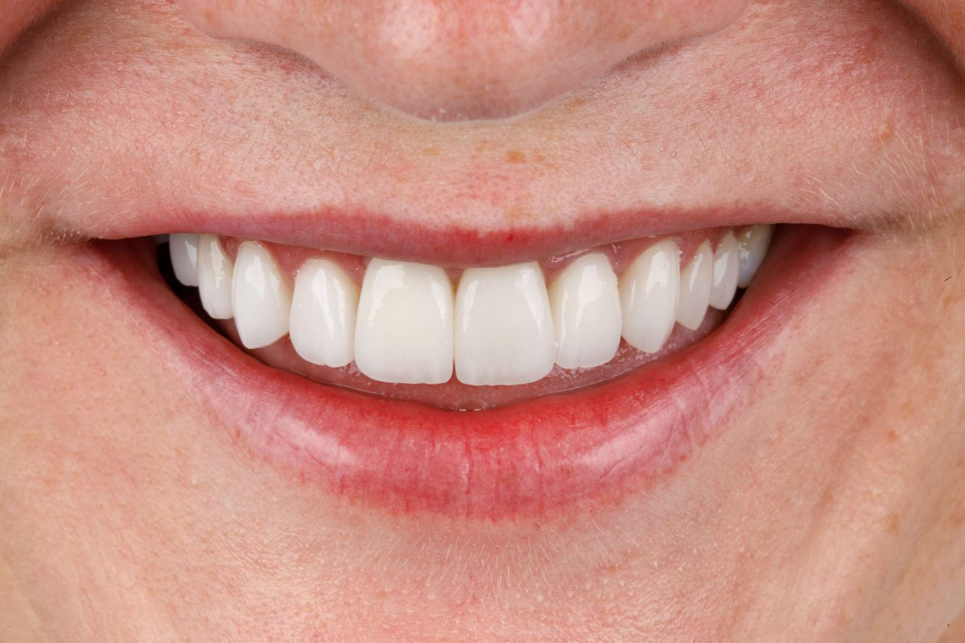 Implantes dentarios com resultados naturais com o uso da tecnologia