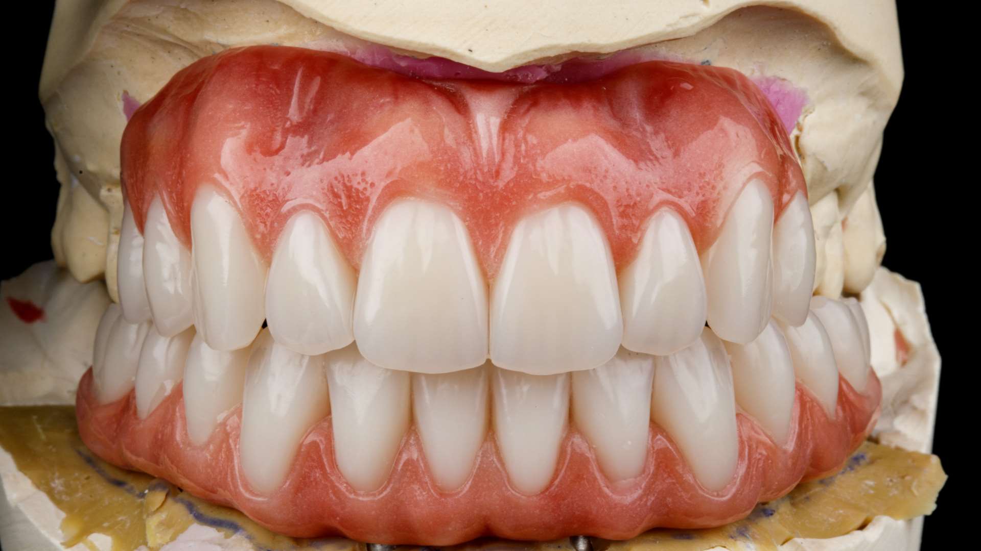 cirurgia guiada em implantes dentarios