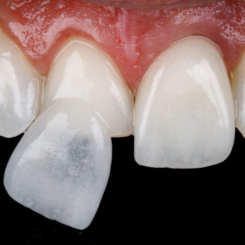 aplicação de faceta dentária em dente anterior para correção estética do sorriso