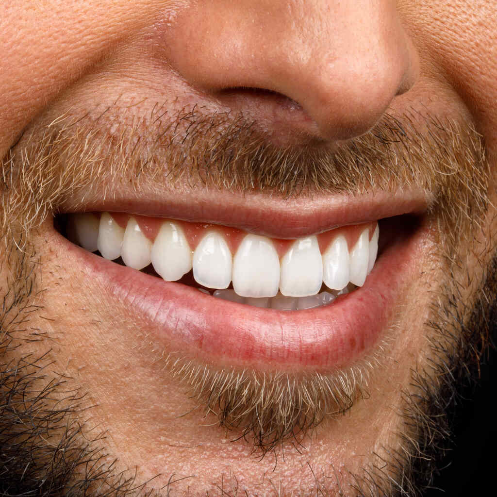 sorriso masculino com facetas dentárias estéticas alinhadas e aparência natural