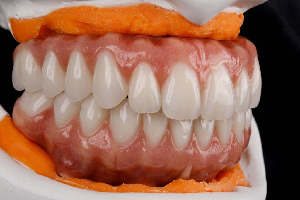 como limpar a protese protocolo implante