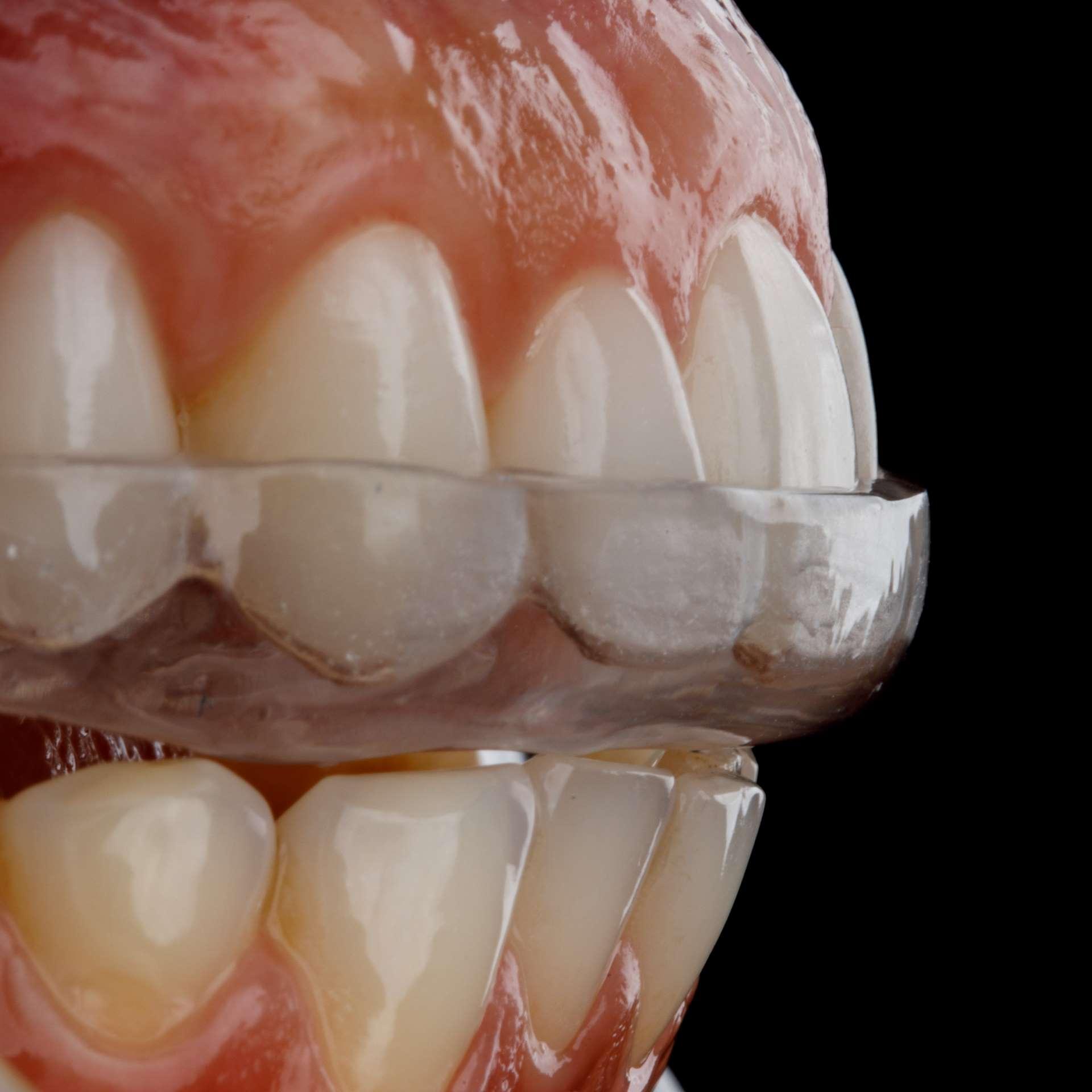 dentes afetados pelo bruxismo