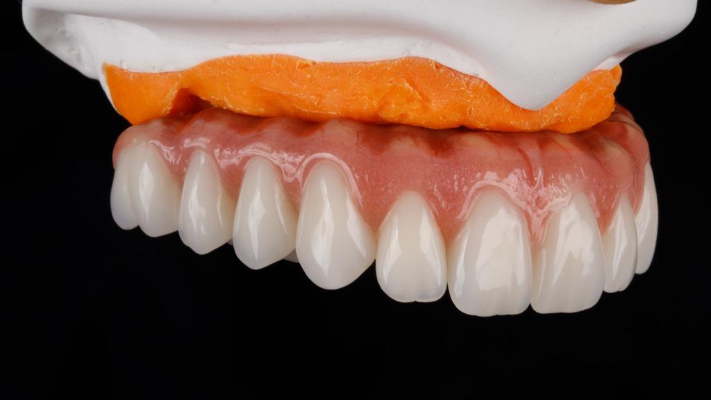 Ajuste de prótese dentária fixa em modelo odontológico durante etapa de instalação