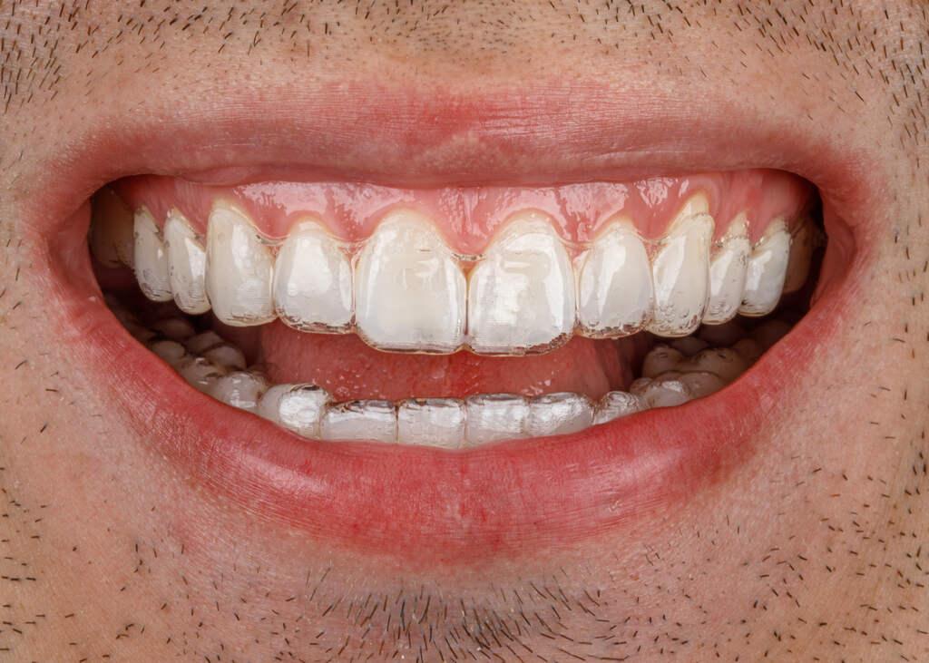 Alinhador invisível ortodôntico nos dentes mostrando opção moderna e discreta de tratamento