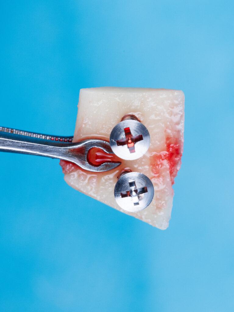 Etapa de como é feito o enxerto ósseo com fixação de estrutura metálica em procedimento dental