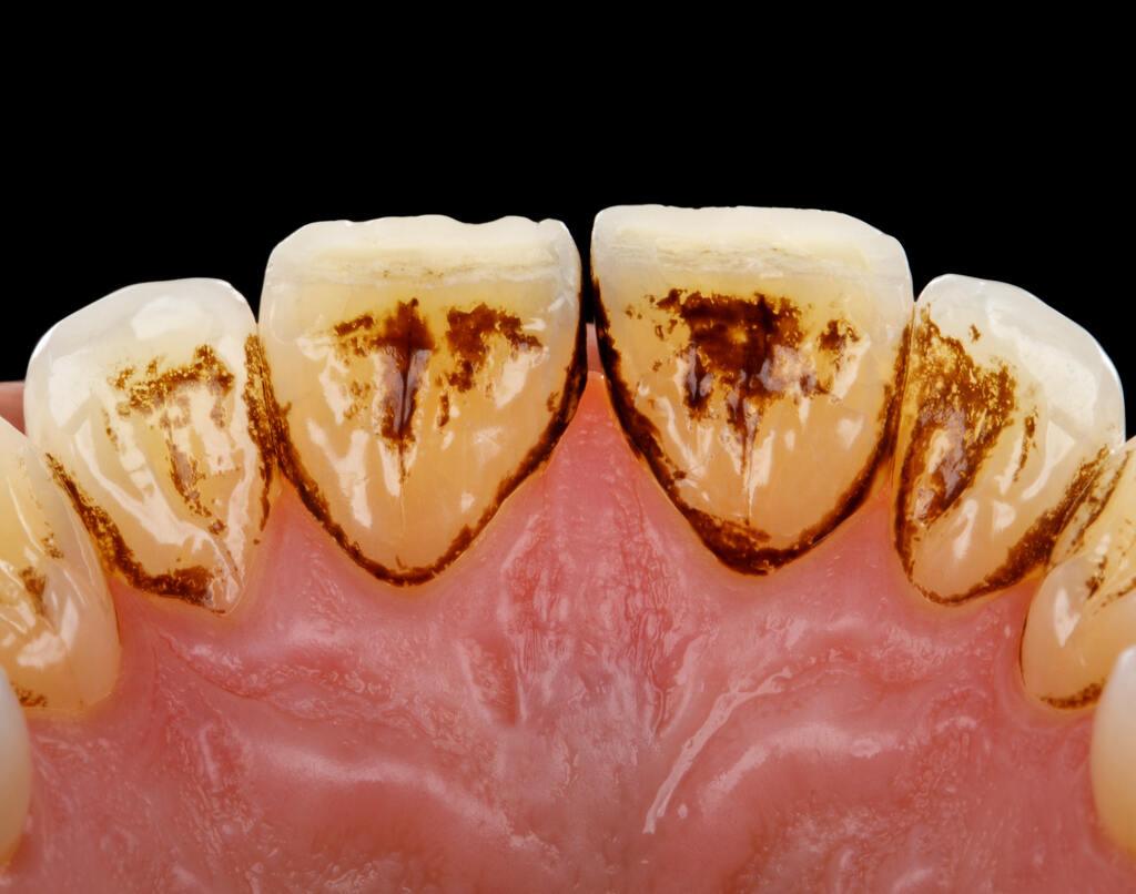Tártaro nos dentes em estágio avançado com acúmulo escuro e endurecido na região da gengiva