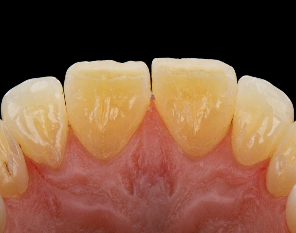 Início da formação de tártaro nos dentes com acúmulo leve de placa bacteriana próxima à gengiva