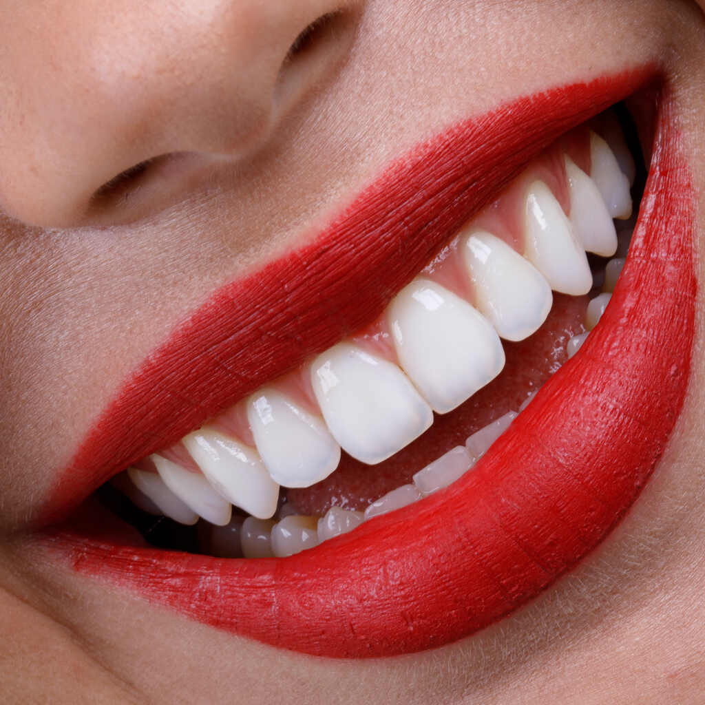 Close de dentes após clareamento dental mostrando uniformidade e brilho do esmalte