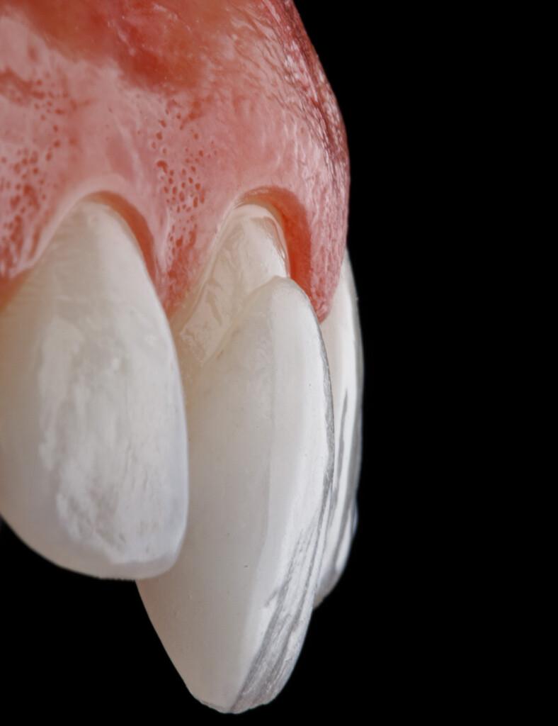 Detalhe de lente de contato dental aplicada sobre os dentes com acabamento estético e natural