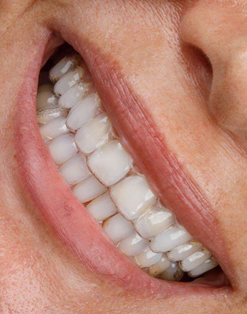 Close em sorriso com alinhador transparente comparando tratamento com aparelho invisível ou fixo