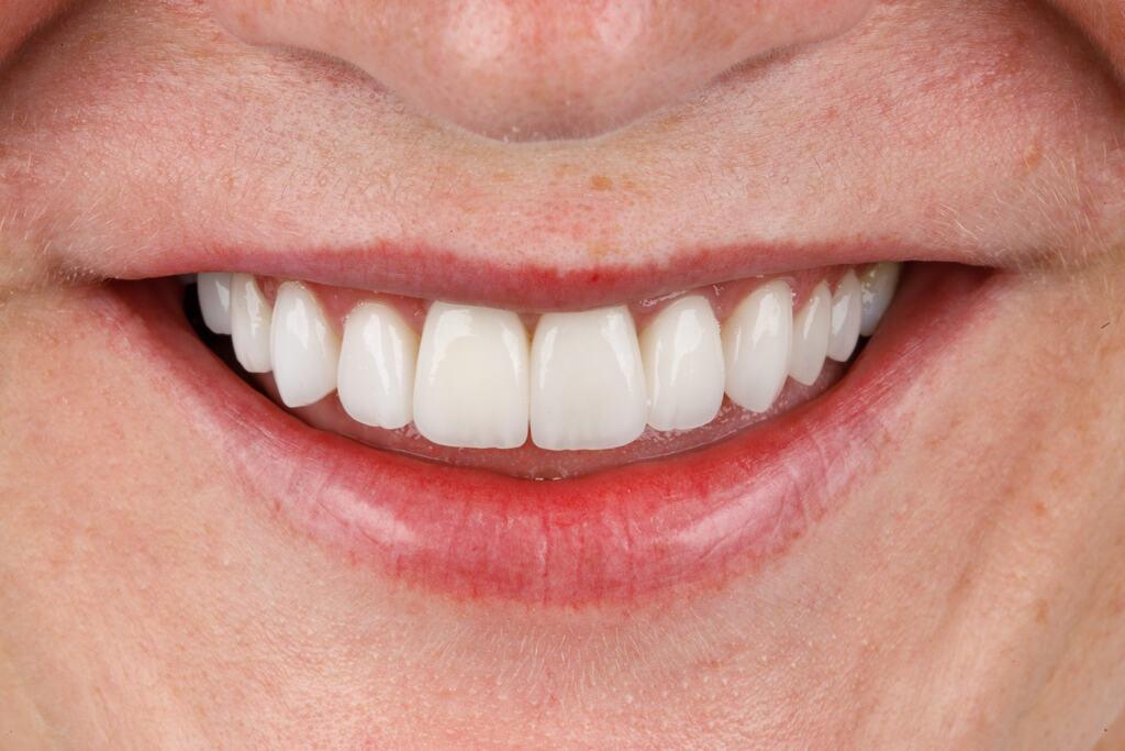 Sorriso com dentes alinhados após recuperação de implante dentário mostrando resultado estético