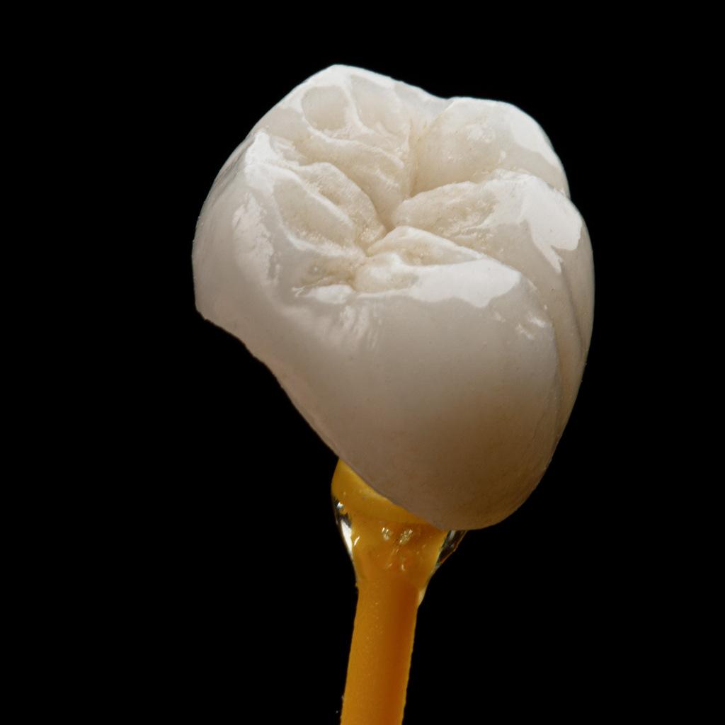Coroa dentária em porcelana utilizada na reabilitação de dentes comprometidos após fratura ou tratamento de canal