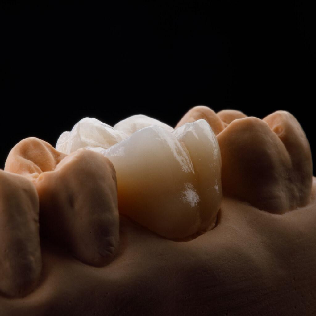 Coroa dentária instalada para restauração de dente danificado, demonstrando recuperação estética e funcional do sorriso