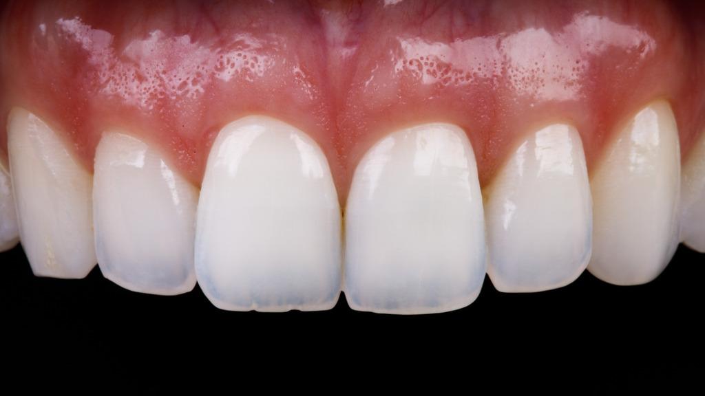 Close dos dentes anteriores após tratamento clareador, destacando cor uniforme e esmalte com aparência saudável.