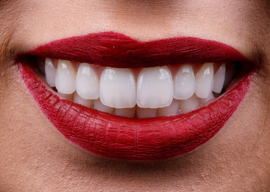 Sorriso com dentes brancos após clareamento dental, ilustrando os resultados de um tratamento para clarear os dentes com segurança.