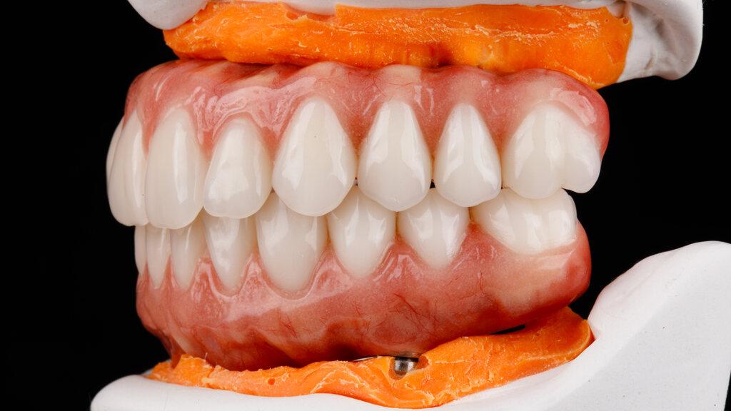 Modelo de prótese total fixa sobre implantes demonstrando como funciona a prótese total fixa na arcada dentária.