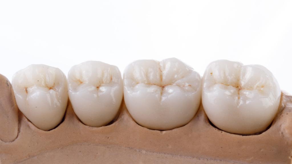 Próteses dentárias unitárias em modelo odontológico, destacando coroas com anatomia e acabamento naturais.