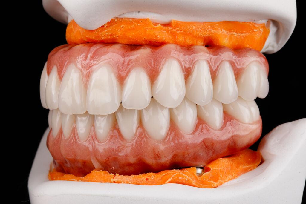 Prótese dentária Joinville: modelo de prótese protocolo sobre implantes com aparência natural e encaixe preciso.