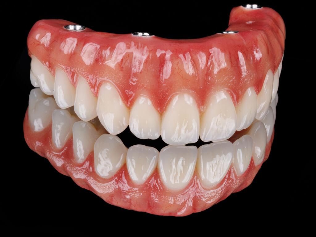 Prótese total fixa sobre implantes com gengiva artificial e dentes protéticos, evidenciando reabilitação oral completa.