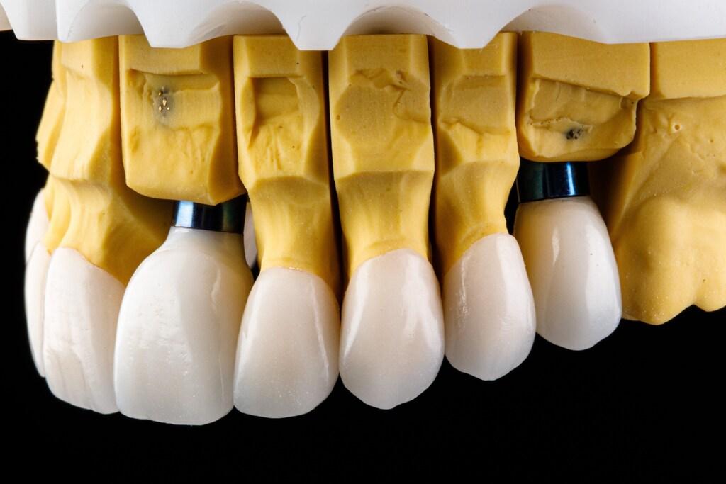 Prótese dentária fixada sobre implantes em modelo odontológico, demonstrando a substituição de dentes ausentes.