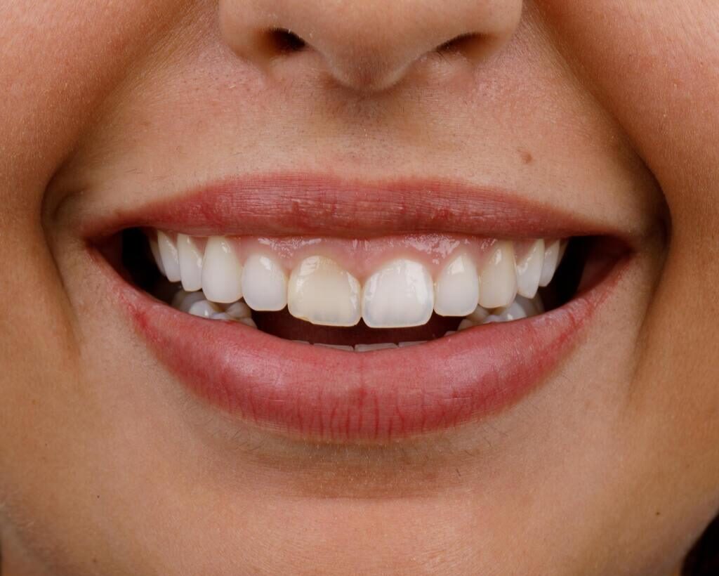Sorriso feminino antes da transformação estética, com dentes naturais avaliados para colocação de lâminas de porcelana.