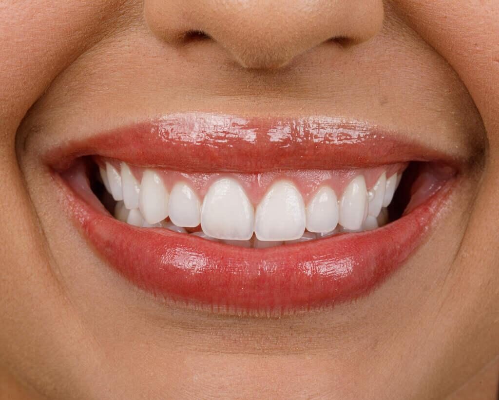 Sorriso feminino após tratamento estético dental, com dentes mais uniformes, claros e harmoniosos.