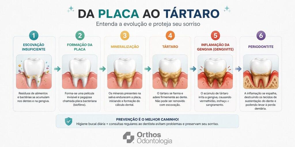 Infográfico mostrando a evolução da placa bacteriana até a periodontite, destacando as etapas de escovação insuficiente, formação da placa, mineralização, tártaro, gengivite e periodontite.