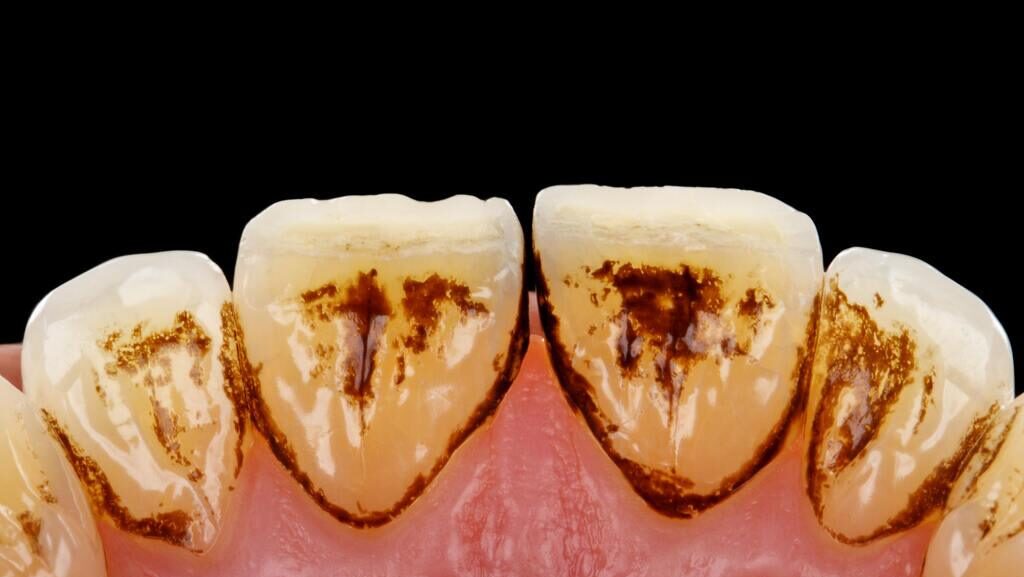 Imagem mostrando acúmulo de tártaro dental na face interna dos dentes inferiores, evidenciando depósitos endurecidos junto à gengiva que podem favorecer gengivite e periodontite.