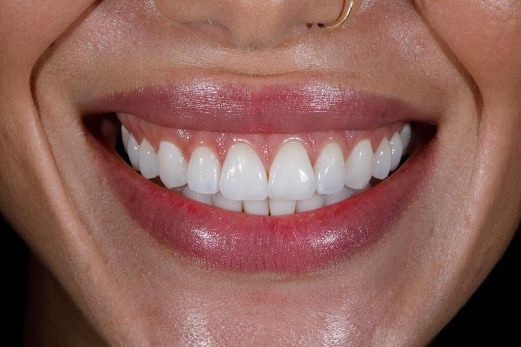 Sorriso com dentes brancos e aparência natural, mostrando o resultado estético do clareamento dental em Joinville.