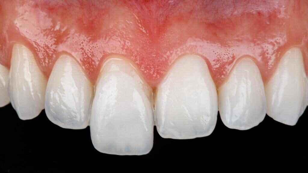 Close dos dentes anteriores superiores com uma faceta posicionada à frente de um incisivo central, ilustrando o tratamento estético.
