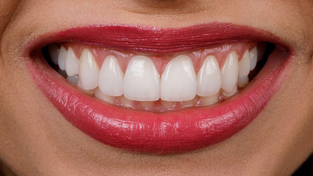 Close de sorriso com lábios rosados e dentes superiores alinhados, destacando a harmonia estética dental.