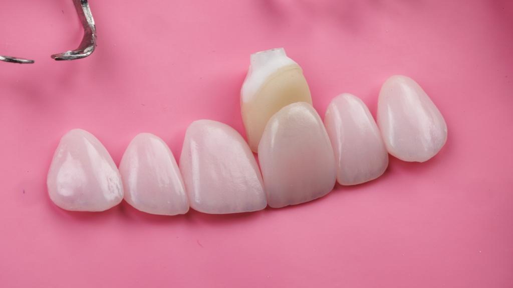 Facetas de porcelana sobre fundo rosa ilustrando o tema faceta dental dói e o preparo para o tratamento.