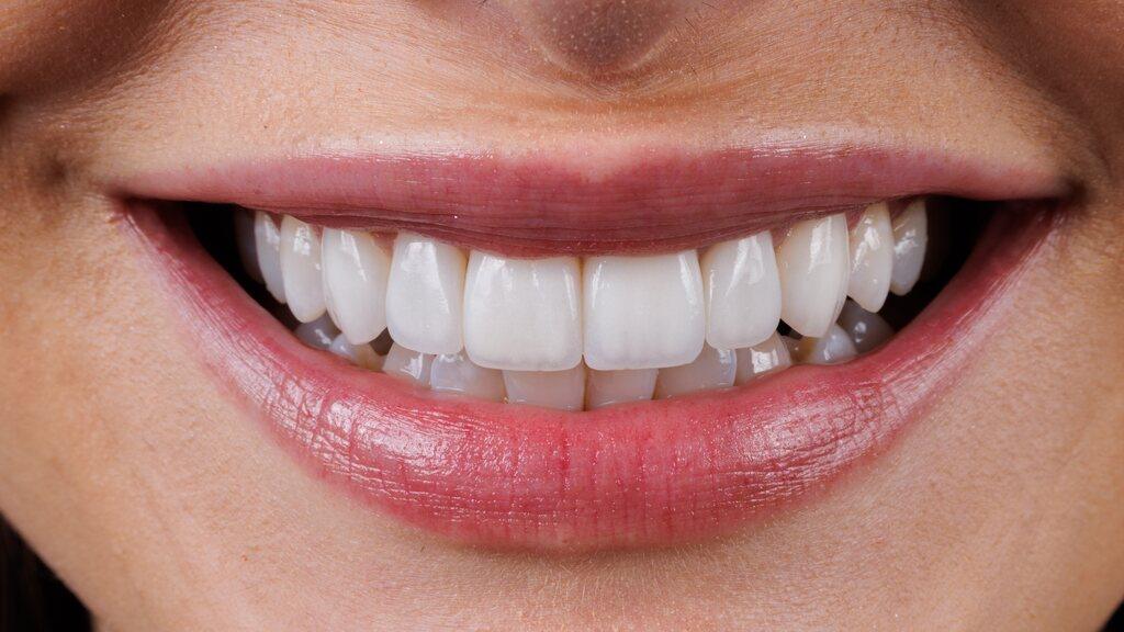 Close do sorriso com facetas de porcelana, destacando estética, adaptação e cuidados após o tratamento.