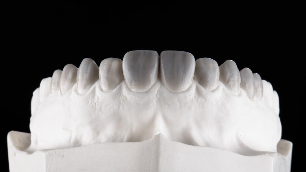 Modelo odontológico com facetas anteriores, ilustrando a manutenção de facetas de porcelana no dia a dia.