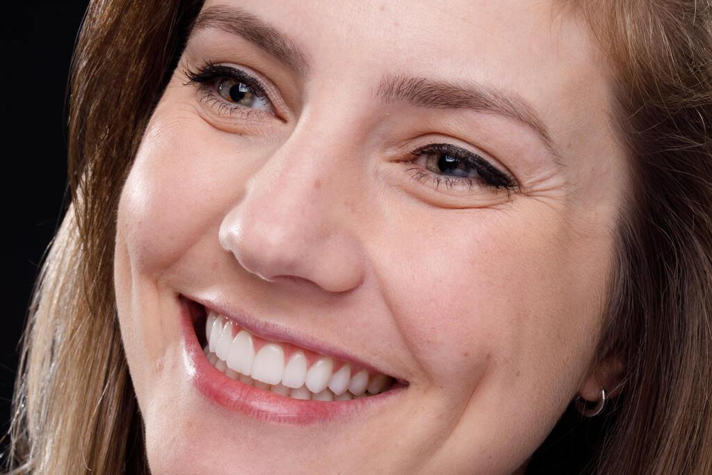 Paciente sorrindo em close com facetas dentárias; facetas dentárias têm garantia e exigem avaliação prévia.