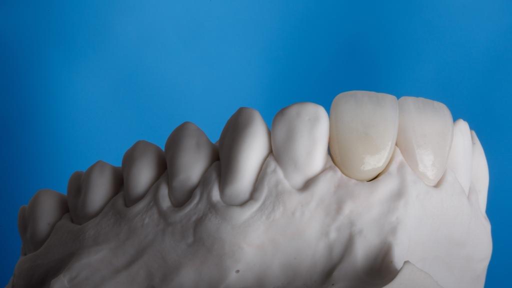 Modelo odontológico com restaurações cerâmicas nos dentes anteriores, ilustrando o planejamento de facetas dentárias.