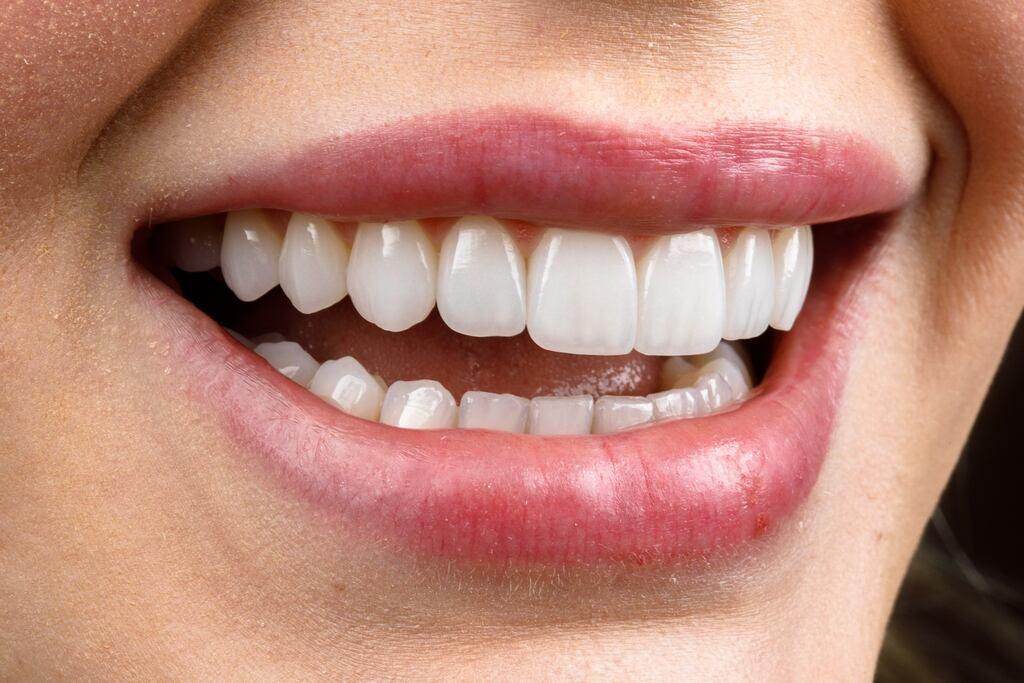 Close de sorriso feminino com dentes claros e alinhados, representando o resultado estético de facetas dentárias.