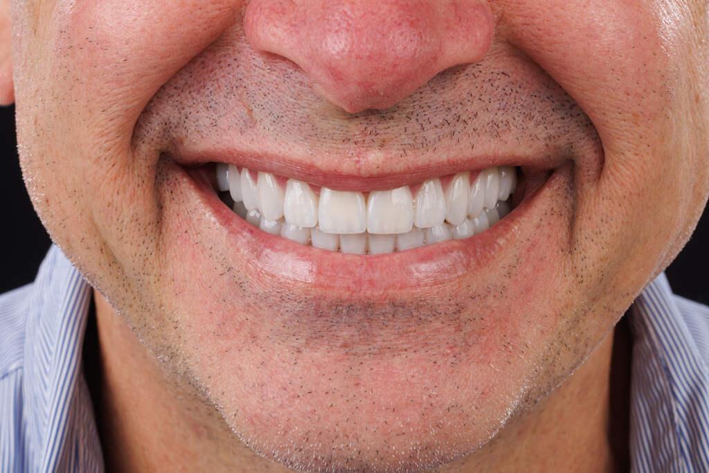 Close do sorriso masculino com dentes claros e alinhados, mostrando resultado estético com facetas dentárias.
